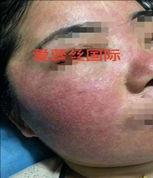 3个月见证“激素脸”华丽蜕变