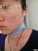 达人分享祛痘经验，不看遗憾终身！